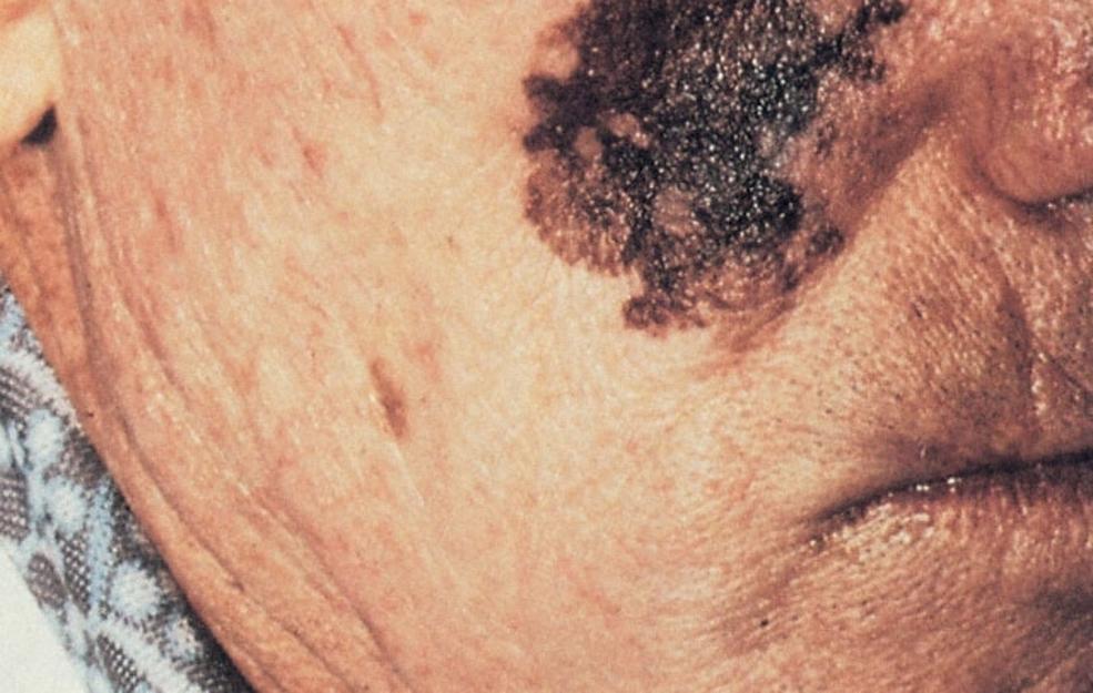 Nodular melanoma picture